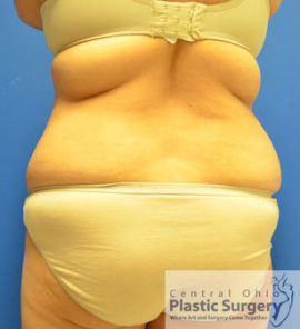 Tummy Tuck