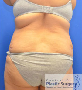 Tummy Tuck