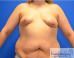 Breast Augmentation with Lift