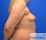 Breast Augmentation with Lift