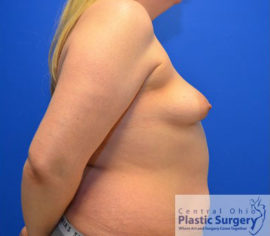 Breast Augmentation with Lift