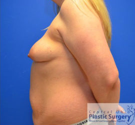 Breast Augmentation with Lift