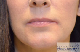 Injectable Fillers/Botox