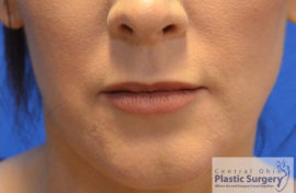 Injectable Fillers/Botox