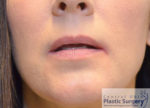 Injectable Fillers/Botox