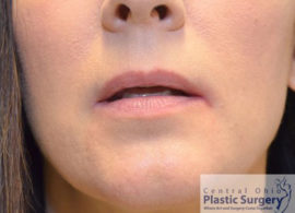 Injectable Fillers/Botox