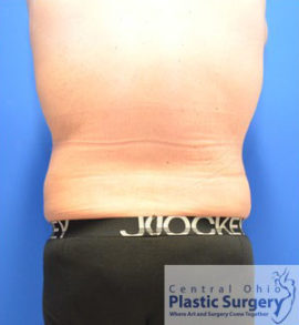 Liposuction