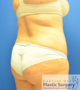 Liposuction