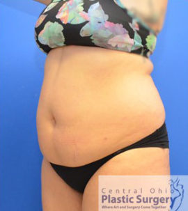 Liposuction Case 15016 Before Photo Liposuction