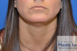 Kybella