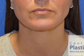 Kybella