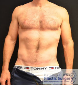 Male Breast Reduction (Gynecomastia)