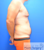 Male Breast Reduction (Gynecomastia)