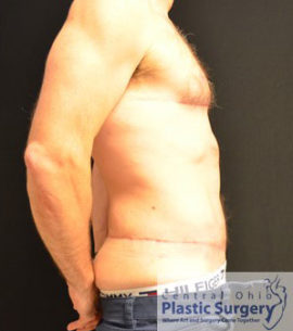 Male Breast Reduction (Gynecomastia)