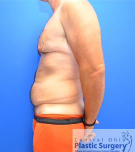 Male Breast Reduction (Gynecomastia)