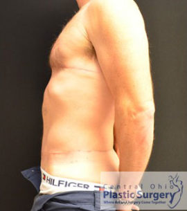 Male Breast Reduction (Gynecomastia)