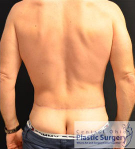 Male Breast Reduction (Gynecomastia)