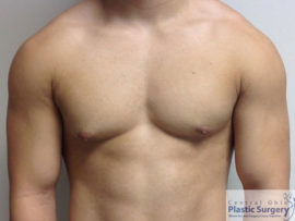 Male Breast Reduction (Gynecomastia)