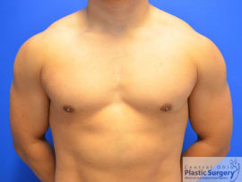 Male Breast Reduction (Gynecomastia)