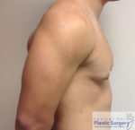 Male Breast Reduction (Gynecomastia)