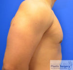 Male Breast Reduction (Gynecomastia)