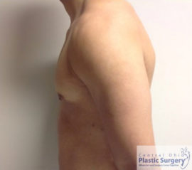 Male Breast Reduction (Gynecomastia)