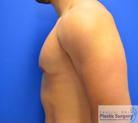 Male Breast Reduction (Gynecomastia)