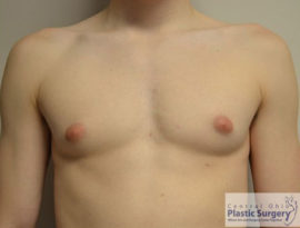 Male Breast Reduction (Gynecomastia)