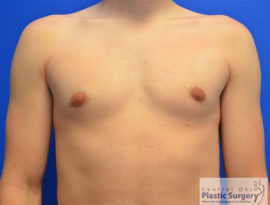 Male Breast Reduction (Gynecomastia)