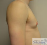 Male Breast Reduction (Gynecomastia)