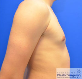 Male Breast Reduction (Gynecomastia)