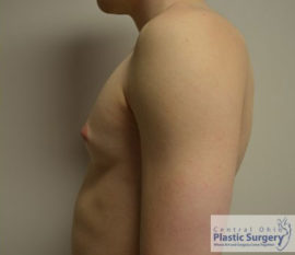 Male Breast Reduction (Gynecomastia)