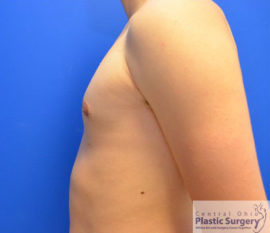 Male Breast Reduction (Gynecomastia)