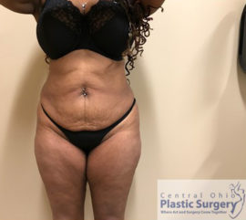 Tummy Tuck