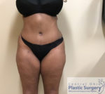 Tummy Tuck