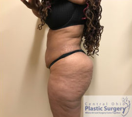 Tummy Tuck