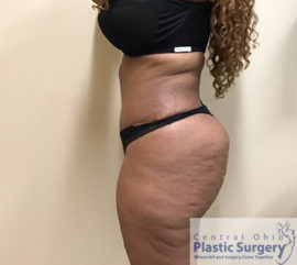 Tummy Tuck