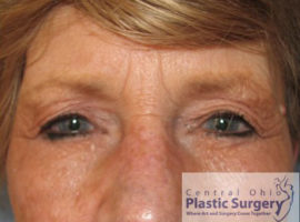 Blepharoplasty