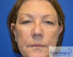 Blepharoplasty