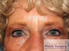 Blepharoplasty