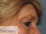 Blepharoplasty