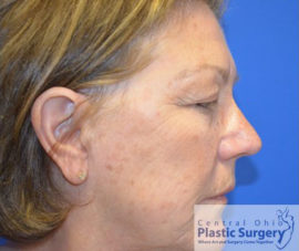 Blepharoplasty