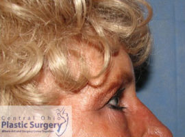 Blepharoplasty