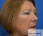 Blepharoplasty