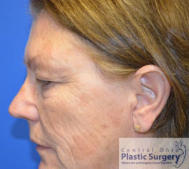Blepharoplasty