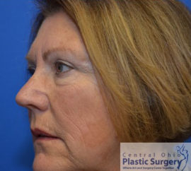Blepharoplasty