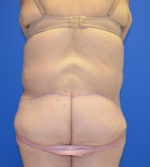 Butt Lift/Brazilian Butt Lift (BBL)