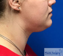 Kybella