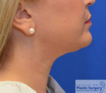 Kybella