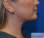 Kybella